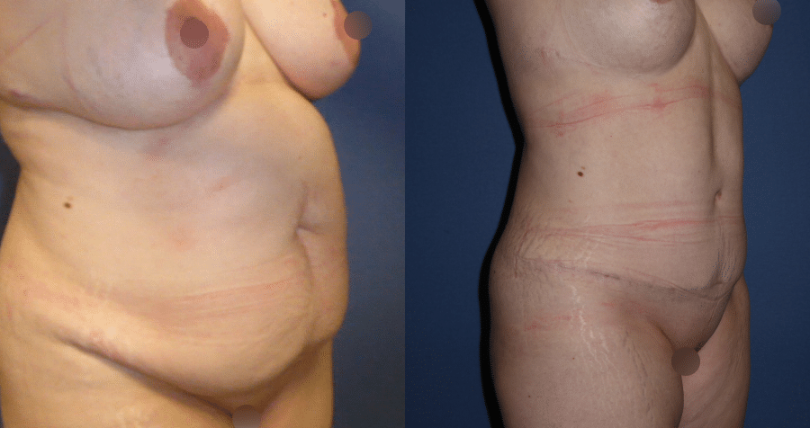 Photos avant et après de la plastie abdominale par Dr Runge