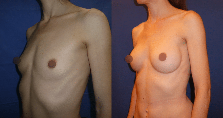 Photo des seins avant et après l'augmentation mammaire réalisée par le Docteur Runge