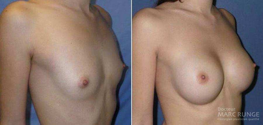 Augmentation mammaire à Paris, Photo avant et après l'opération réalisée par le Dr Marc Runge