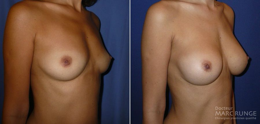 Photos du traitement de l'hypotrophie mammaire par augmentation mammaire - Dr Runge
