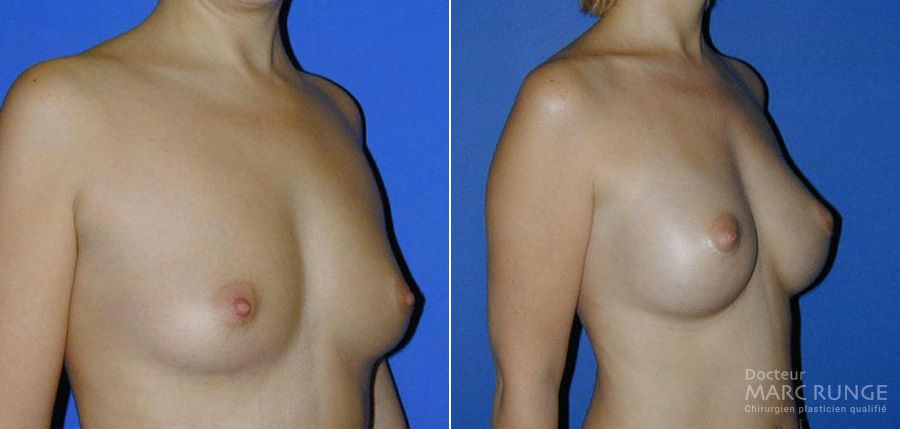 Photo des seins d'après l'augmentation mammaire réalisée par le Dr Runge, chirurgien esthétique renommé à Pairs et Beauvais (Oise)