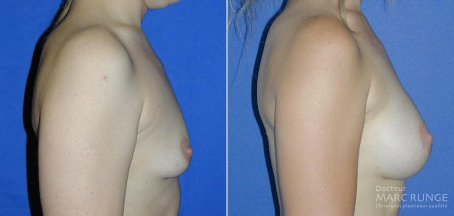 L'opération d'une augmentation mammaire en photos avant et après par le Dr Runge, chirurgien esthétique à Paris et Beauvais (Oise)
