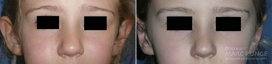 Chirurgie des oreilles décollées photos avant et après - Dr Runge, Paris et Beauvais (Oise)