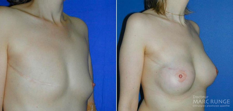 Reconstruction mammaire, photos avant et après par Dr Runge, chirurgien esthétique à Paris et Beauvais (Oise)