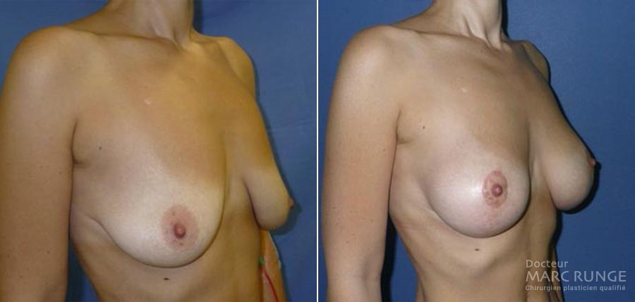 Résultats du lifting des seins en Photos avant/après, une opération réalisée à Paris par Dr Runge, chirurgien et médecin esthétique