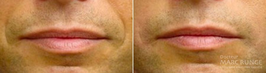 Photos sillons naso-géniens avant et après injection d'acide hyaluronique, Dr Runge, Paris et Beauvais