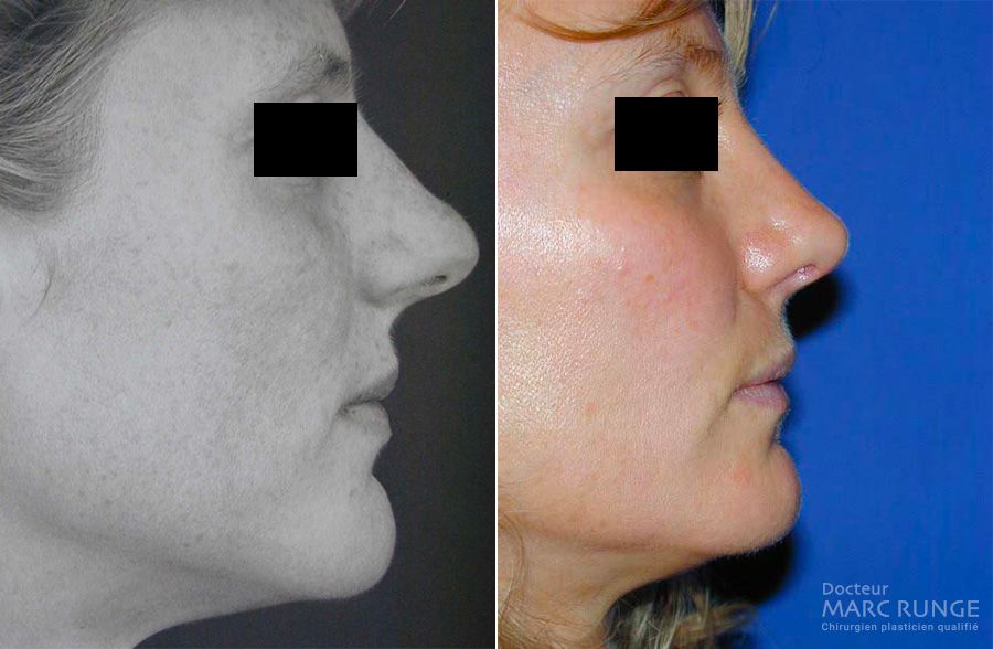 Photos avant/après rhinoplastie (chirurgie du nez) - Dr Runge - Chirurgien esthétique à Paris et Beauvais