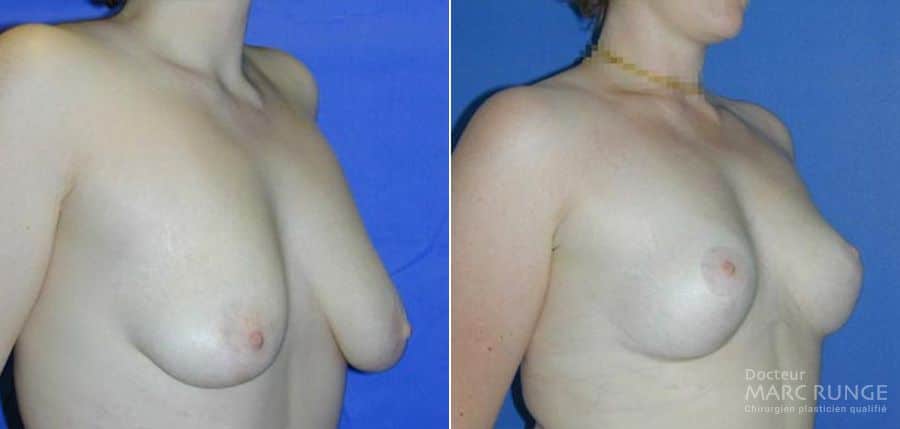 Résultats du lifting des seins (ptose mammaire) en photos, l'opération est réalisée à Paris par le Dr Runge, chirurgien et médecin esthétique