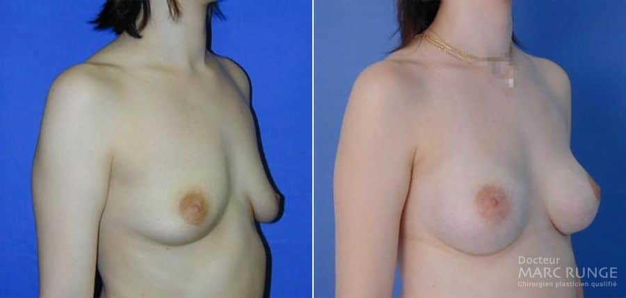 Résultats du lifting des seins, Photos avant/après par Dr Runge, chirurgien et médecin esthétique Paris et Beauvais (Oise)