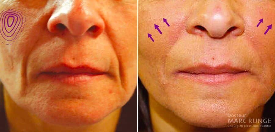 Lipofilling visage photos avant et après par Docteur Runge, médecin et chirurgien esthétique à Paris et Beauvais (Oise)