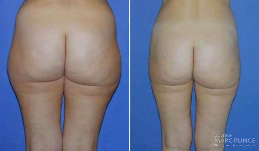 Liposuccion des hanches en photos avant et après, par Dr Runge, chirurgien esthétique à Paris et Beauvais (Oise)