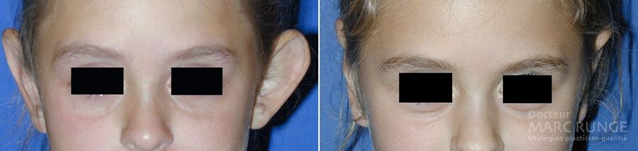 Dr Runge, photos de la chirurgie des oreilles décollées avant et après l'opération (Paris et Beauvais)