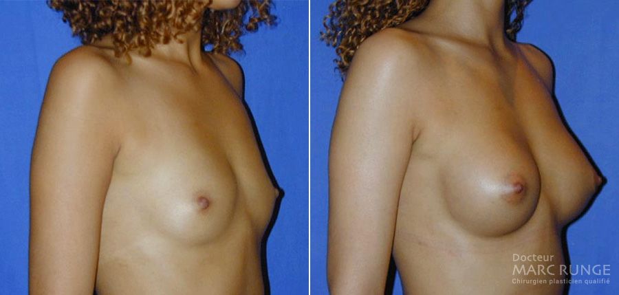 Photo des seins avant et après l'augmentation mammaire réalisée par le Docteur Runge à Paris et Beauvais (Oise)
