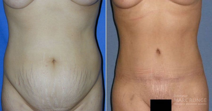 Abdominoplastie Paris, photos avant et après par Dr Runge, spécialiste de la plastie abdominale et de la chirurgie esthétique