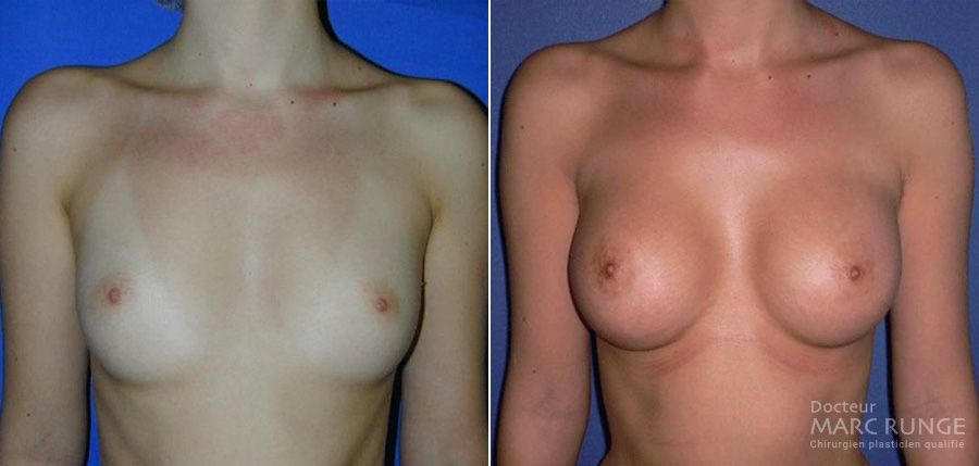 Photo seins avant/après augmentation mammaire réalisée par le Dr Runge, chirurgien esthétique à Paris et Beauvais (Oise)