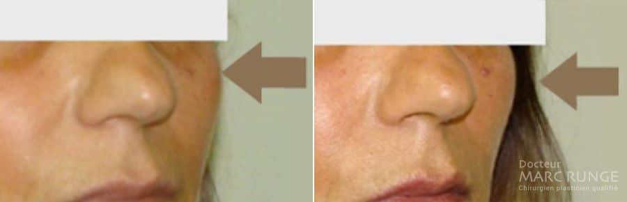 Photo avant/après, résultats fils tenseurs : une technique efficace du lifting visage pratiquée à Paris par Dr Runge