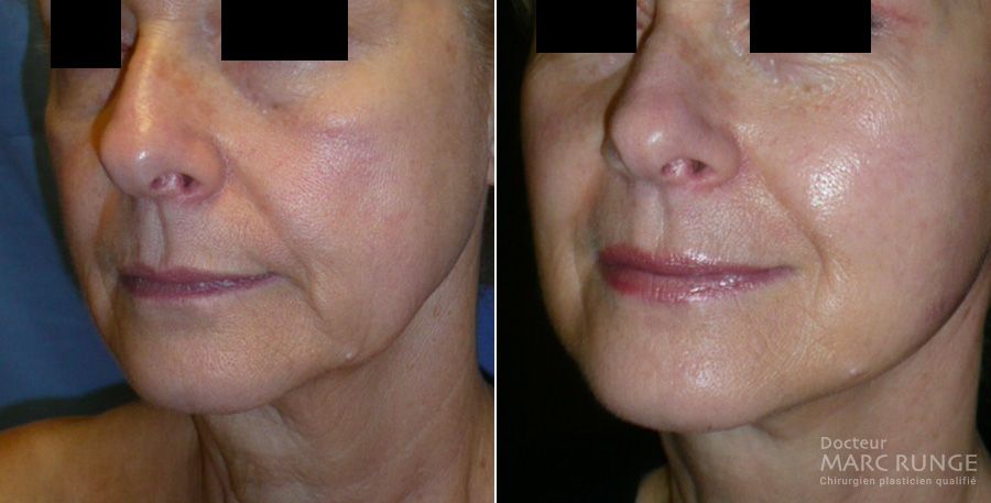 Photos visage avant/après un lifting cervico-facial par le Dr Runge, chirurgien esthétique à Paris et Beauvais