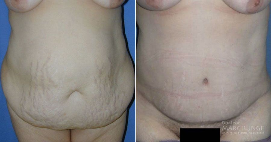 Photos avant et après de l'abdominoplastie par Dr Runge, chirurgien esthétique Paris et Beauvais (Oise)