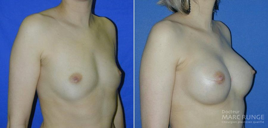 Photo seins avant et après augmentation mammaire réalisée par le Dr Runge, chirurgien esthétique à Paris et Beauvais (Oise)