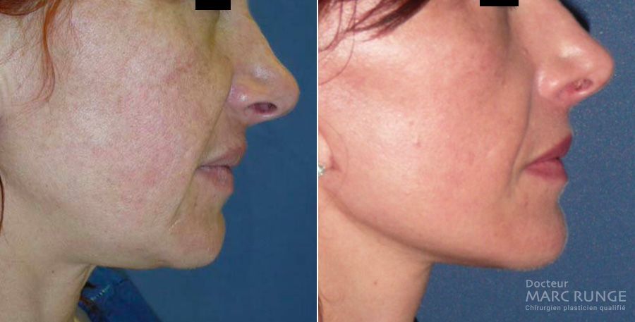 Photos avant/après traitement du relachement du visage par lifting cervico-facial - Dr Runge