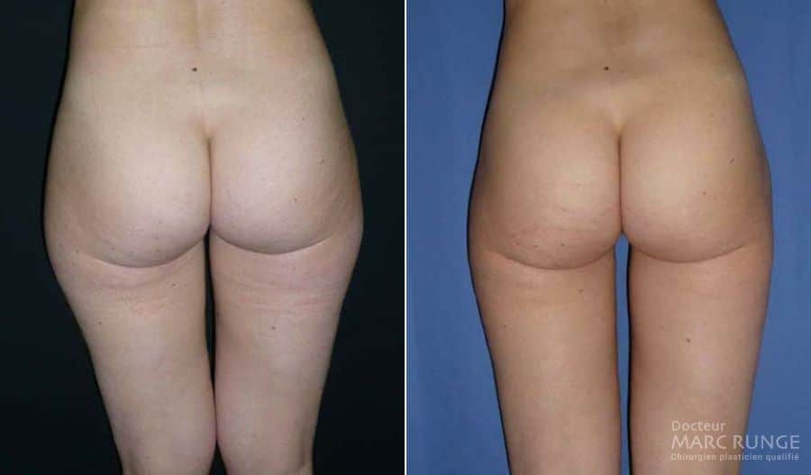 Photos de la Liposuccion des fesses avant et après la chirurgie esthétique réalisée par Dr Runge à Paris