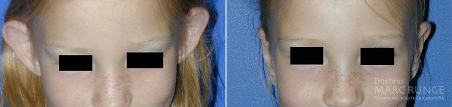 Opération des oreilles décollées photos avant et après , par Dr Runge, chirurgien esthétique à Paris et Beauvais (Oise)