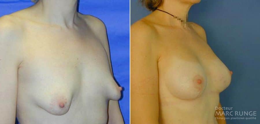 Photos du Lifting des seins avant/après, opération réalisée à Paris par Dr Runge, chirurgien et médecin esthétique