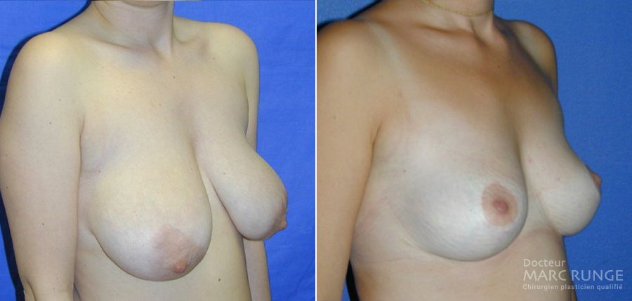 Réduction mammaire, photos par Dr Runge, chirurgien esthétique Paris et Beauvais (Oise)