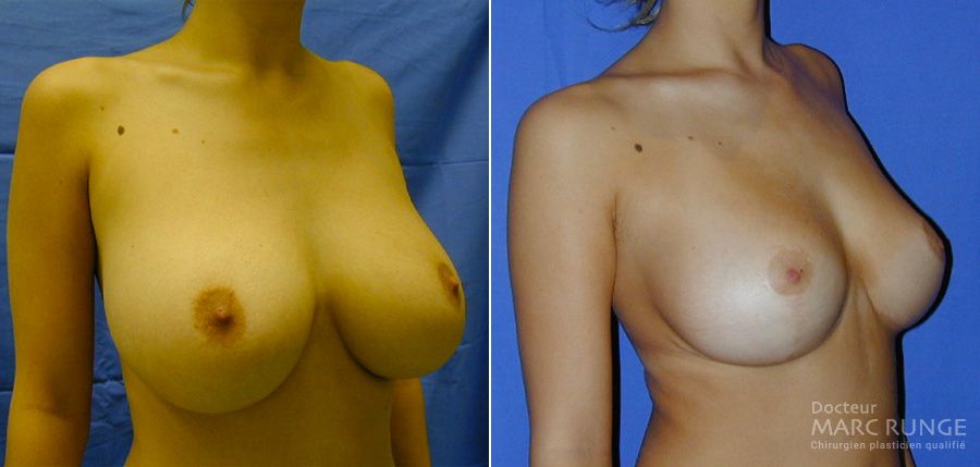 Photos avant et après d'une réduction mammaire - Dr Runge, Paris et Beauvais (Oise)