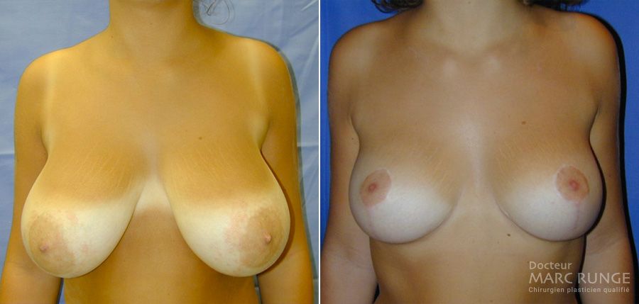 Photos du résultat de la réduction mammaire par Dr Runge, chirurgien esthétique Paris, photos avant/après
