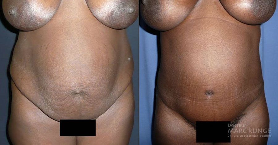 Plastie abdominale Paris, photos avant et après par Dr Runge, spécialiste de l'abdominoplastie et de la chirurgie esthétique