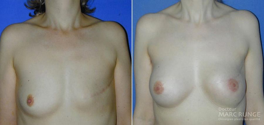 Photos reconstruction mammaire avant et après par Dr Runge, chirurgien esthétique, Paris et Beauvais (Oise)