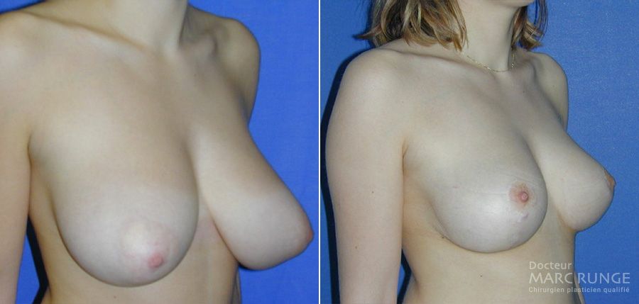 La réduction mammaire, photos - Dr Runge, chirurgien esthétique Paris et Beauvais (Oise)