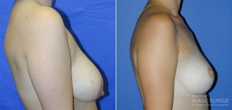 Photos réduction mammaire avant et après par Dr Runge, chirurgien esthétique Paris et Beauvais (Oise)