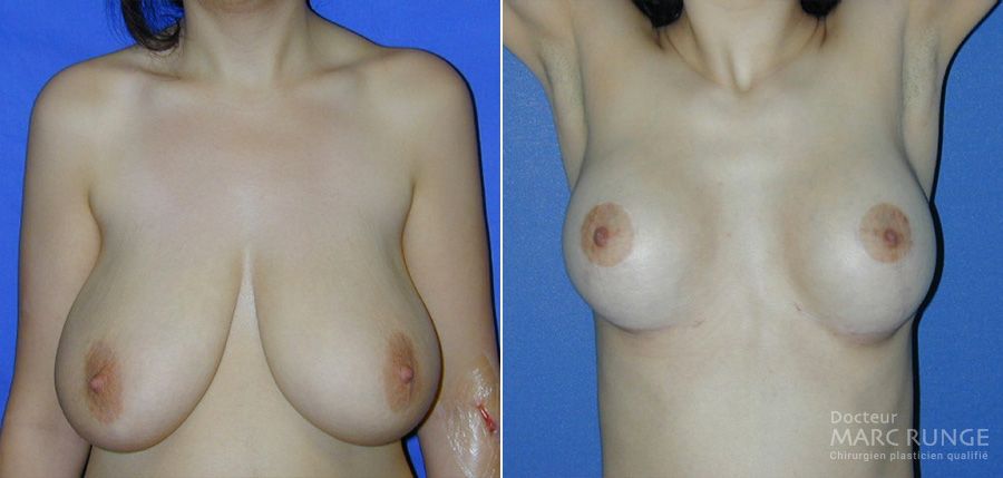 photos avant et après de la réduction mammaire à Paris par Dr Runge, chirurgien esthétique et Beauvais (Oise)