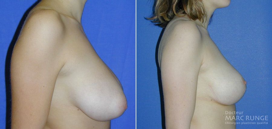 Le résultat de la réduction mammaire par Dr Runge, chirurgien esthétique à Paris et Beauvais (Oise)