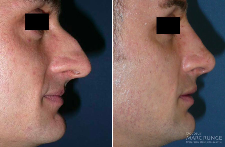 Chirurgie esthétique du nez, photos avant/après - Dr Runge - Chirurgien esthétique à Paris et Beauvais