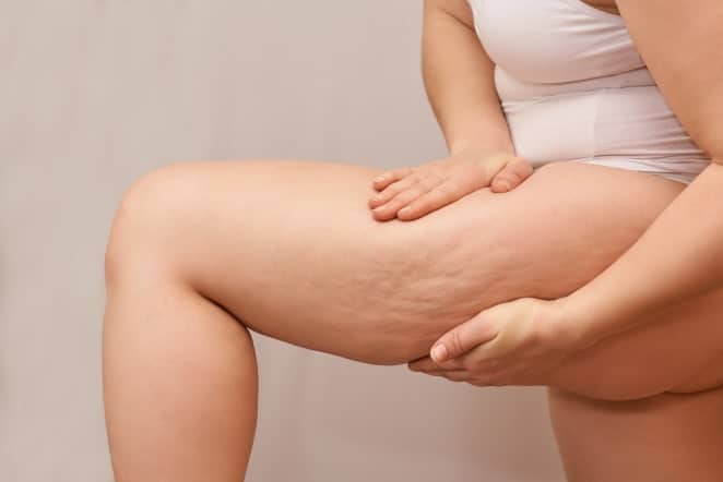 Est-ce que la liposuccion est une solution pour traiter l'obésité ? | Dr Runge | Paris
