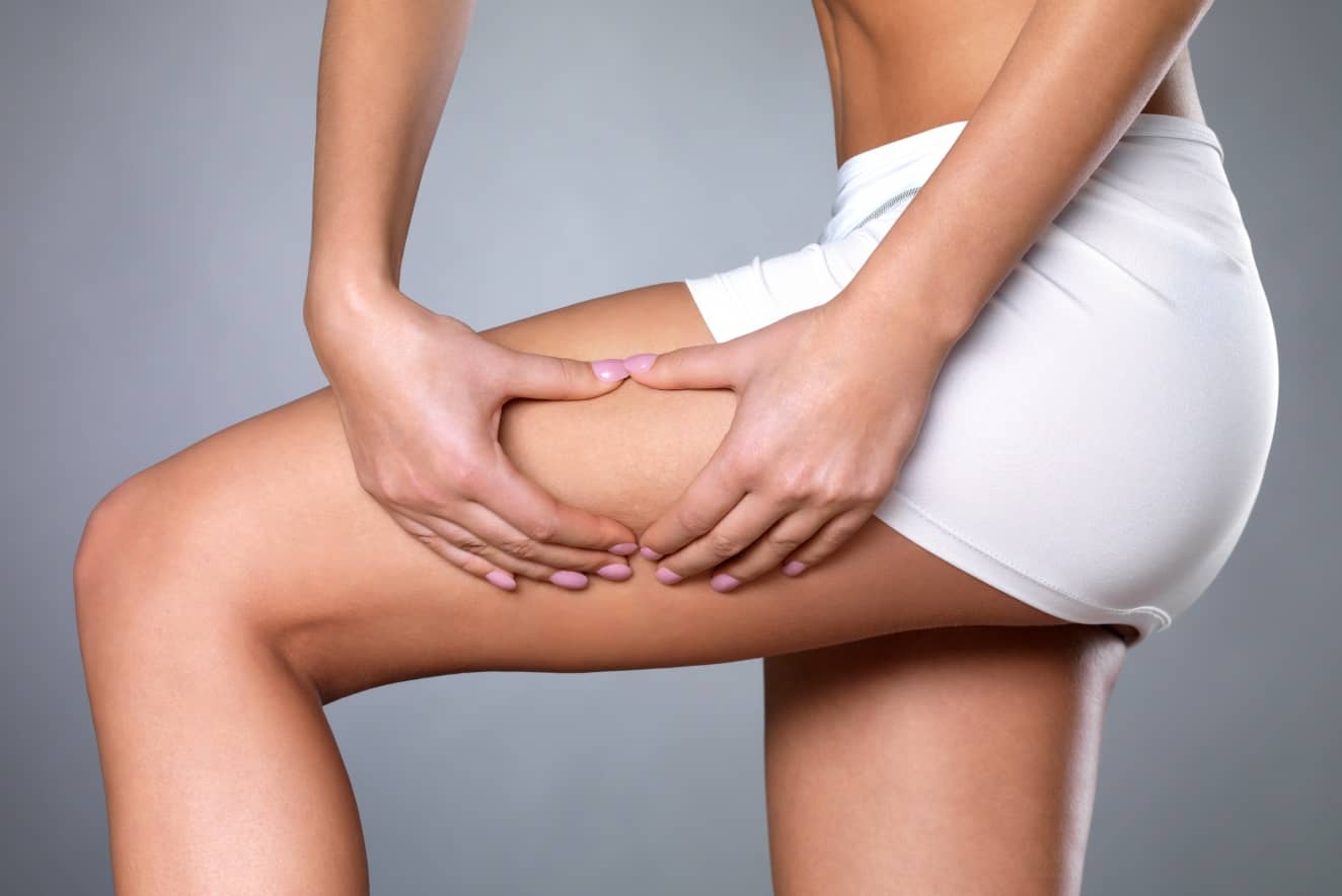 La liposuccion pour éliminer la cellulite | Dr Runge | Paris 7 et Paris 15